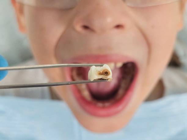 Best Emergency Treatment for Oral Infections in Wofford Heights, CA